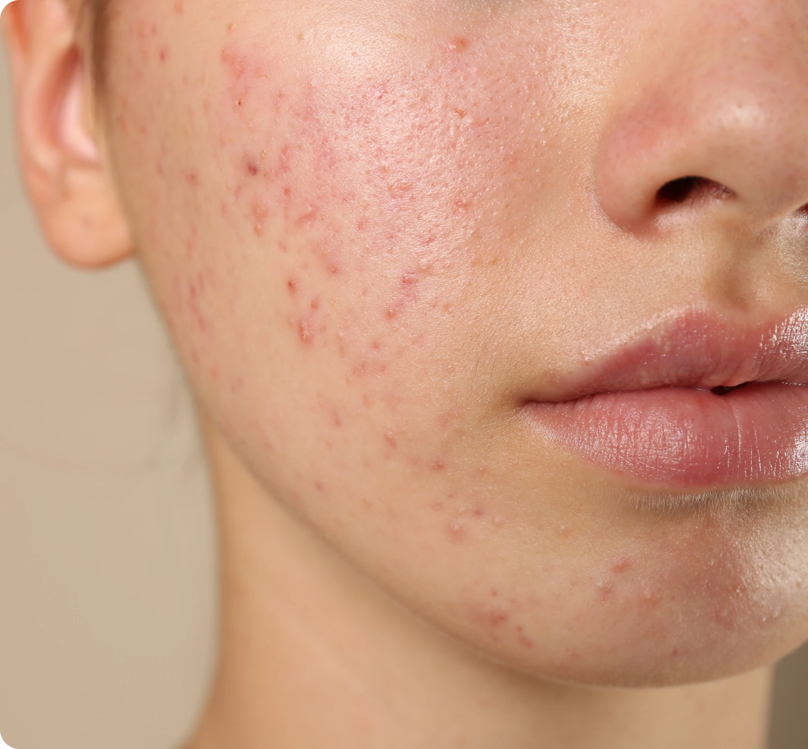 Facial Treatments in South Boston, MA: AviClear Banner