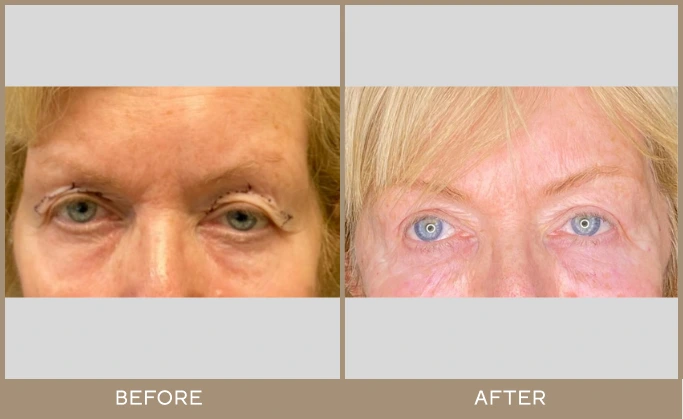 bleplaroplasty