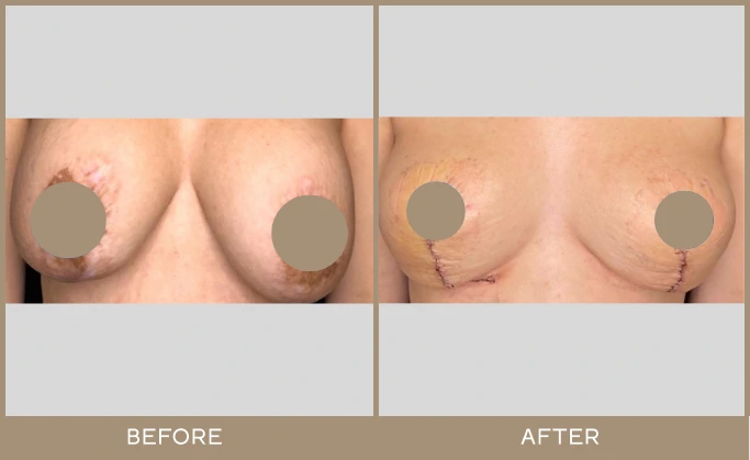 breast lifts 2