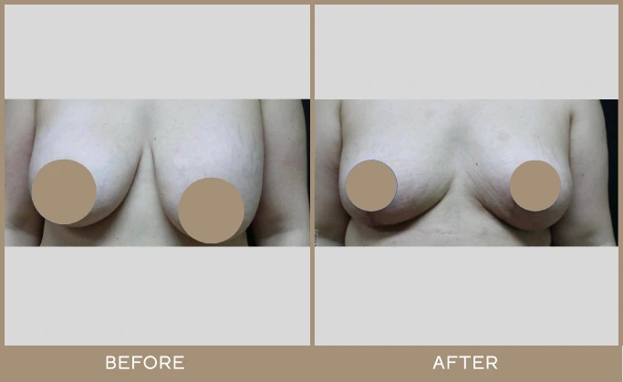 breast lifts 3