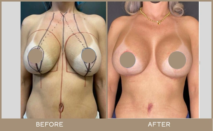 breast lifts 4