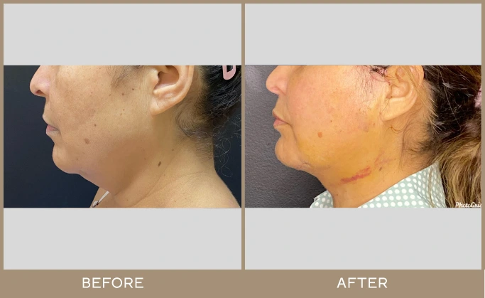 chin lipo 1