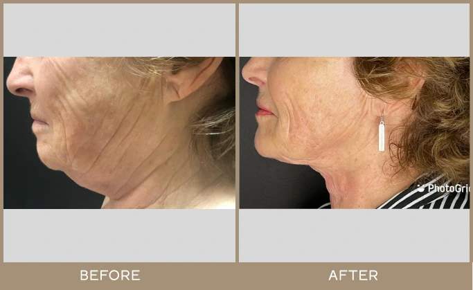chin lipo 2
