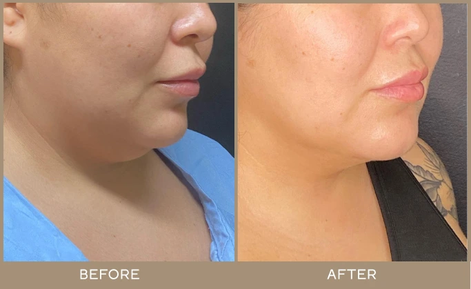 chin lipo 3