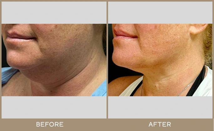 chin lipo 5