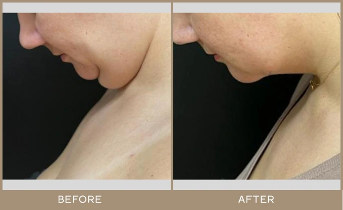 chin lipo 6.1