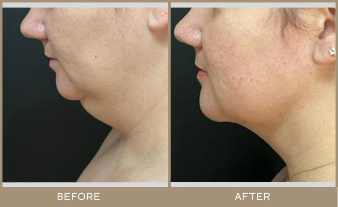 chin lipo 6