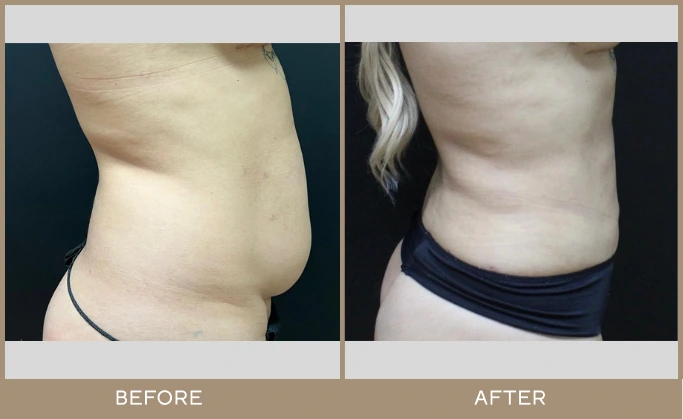 regeneris lipo 1.1