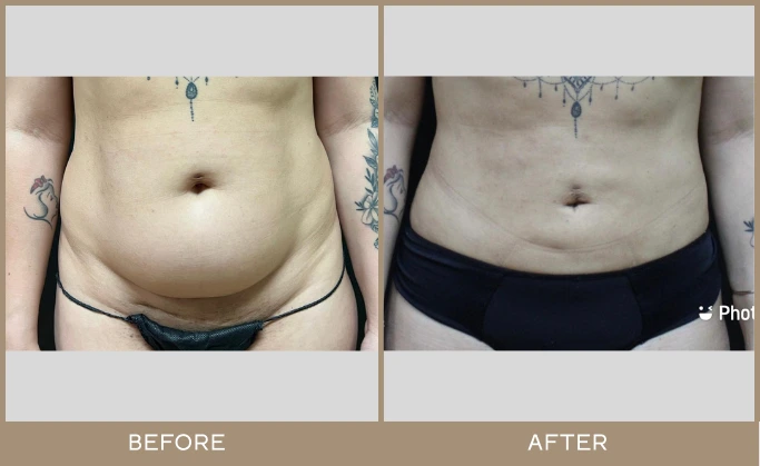 regeneris lipo 1