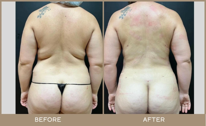 regeneris lipo 2