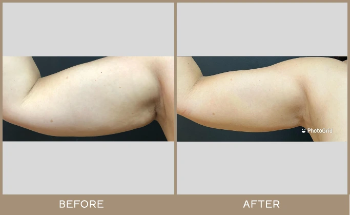 regeneris medspa Lipo 13