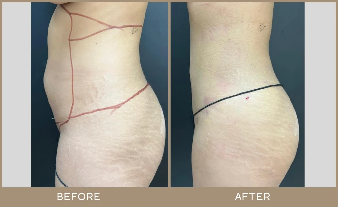 regeneris medspa Lipo 14