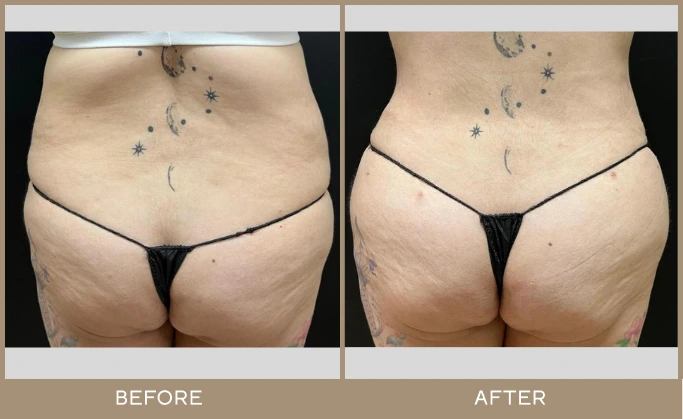 regeneris medspa Lipo 15