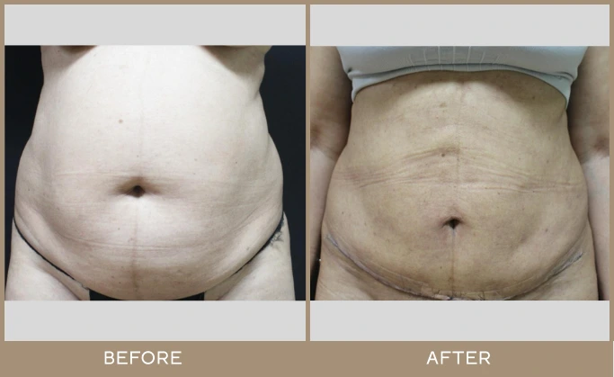 regeneris medspa Lipo 18