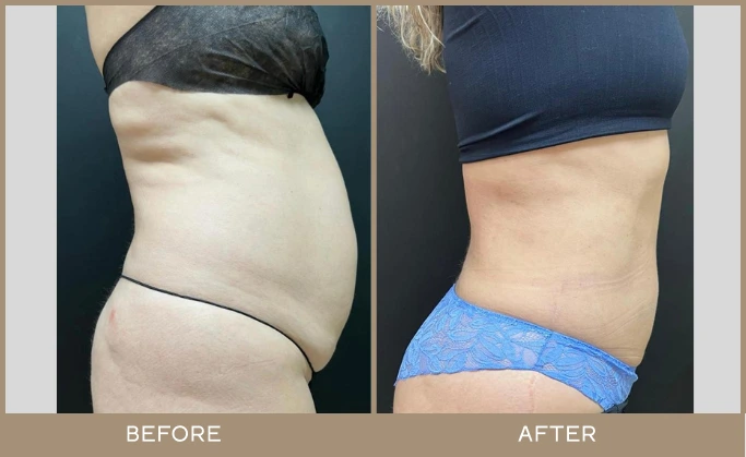 regeneris medspa Lipo 19