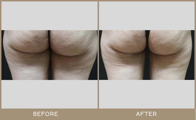 regeneris medspa Lipo 20