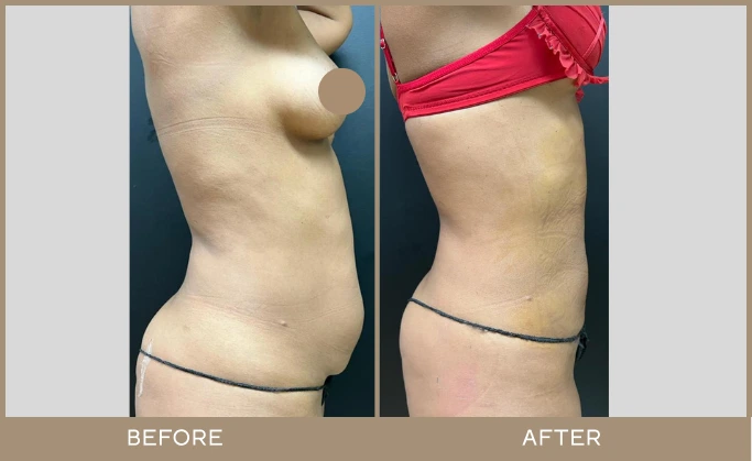 regeneris medspa lipo 10