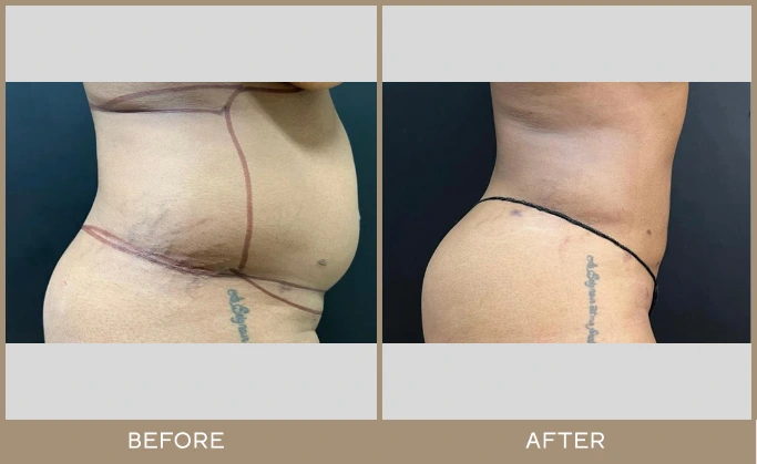 regeneris medspa lipo 11