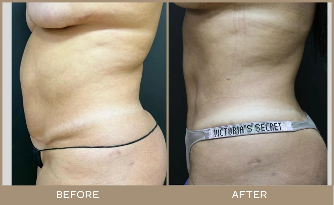 regeneris medspa lipo 17