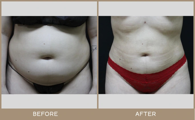 regeneris medspa lipo 3
