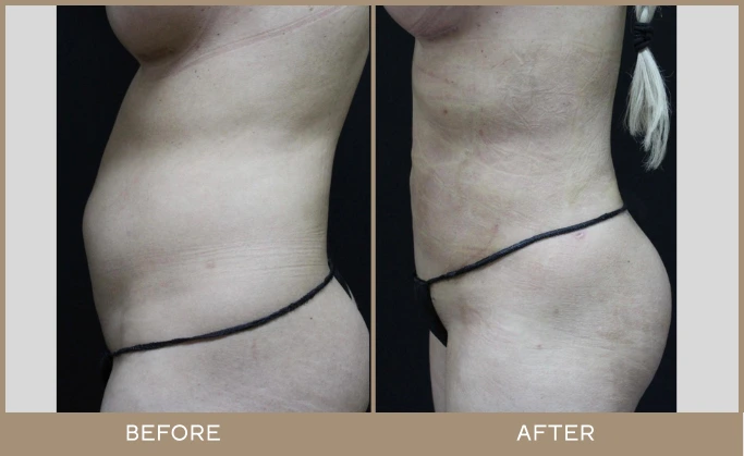regeneris medspa lipo 4