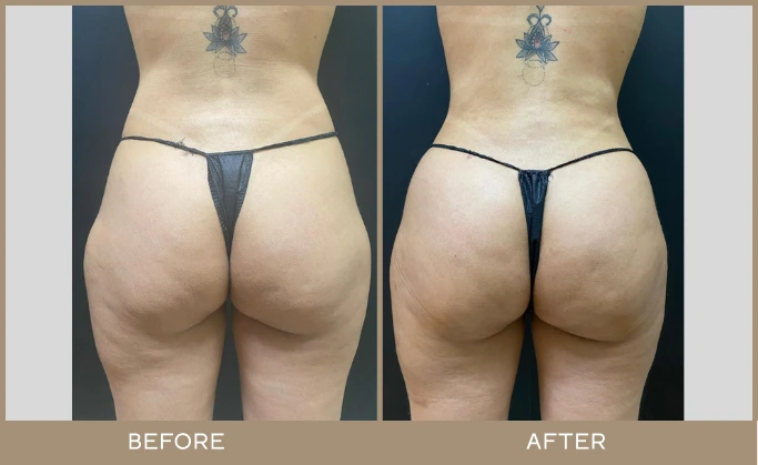 regeneris medspa lipo 5