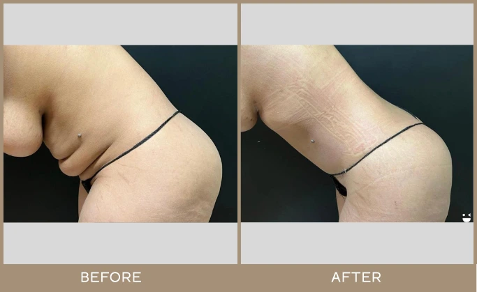 regeneris medspa lipo 6