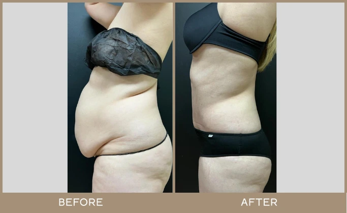 regeneris medspa lipo 7