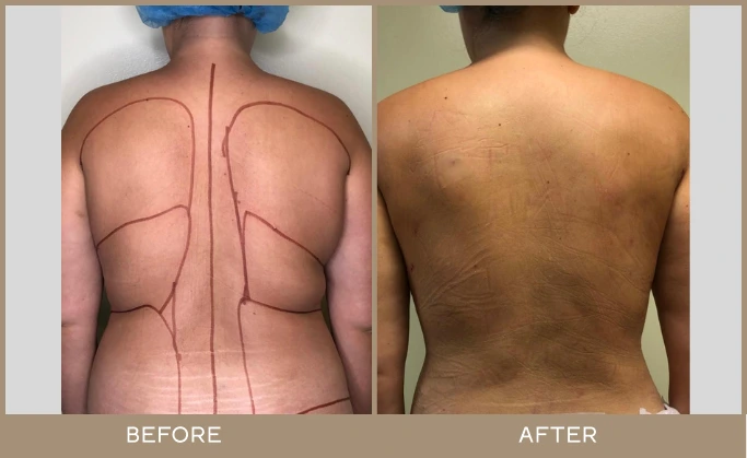 regeneris medspa lipo 8