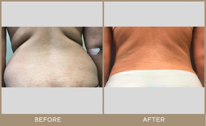 regeneris medspa lipo 9