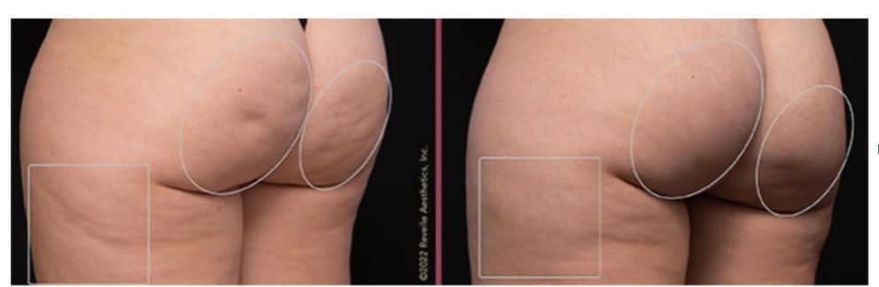 How to Get Started with Cellulite Treatment