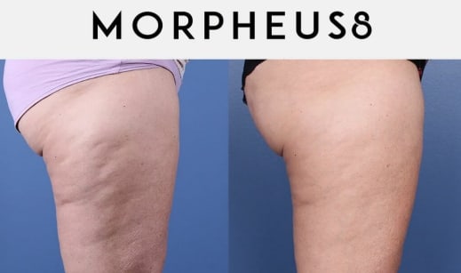 Microneedling with radiofrequency (Morpheus8)