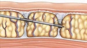 Subcision Procedure