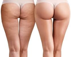 The Evolution of Cellulite Treatments