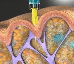 The Future of Cellulite Treatment