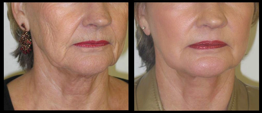 The Neck Rejuvenation Dilemma: Addressing Sagging Skin
