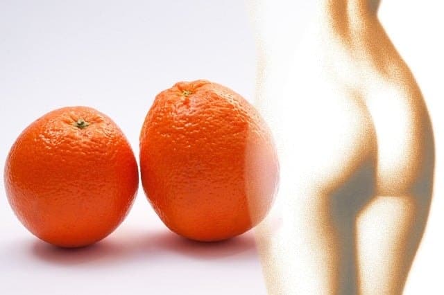 What Exactly Is Cellulite