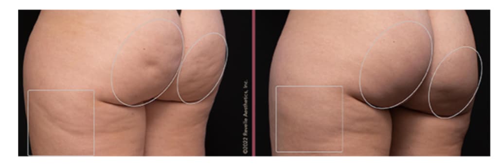 What Exactly Is Cellulite?