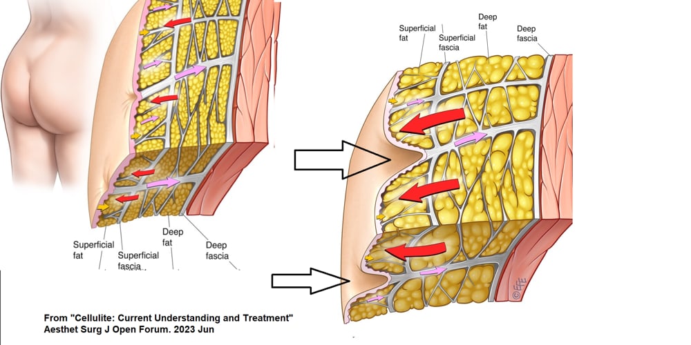 What Is Cellulite, and Why Does It Occur?