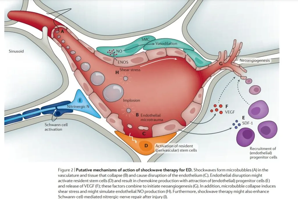 Low-Intensity Shockwave Therapy